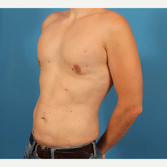 35 year old man treated with Male Breast Reduction + Liposuction after 3298145