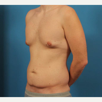 35 year old man treated with Male Breast Reduction + Liposuction before 3298145