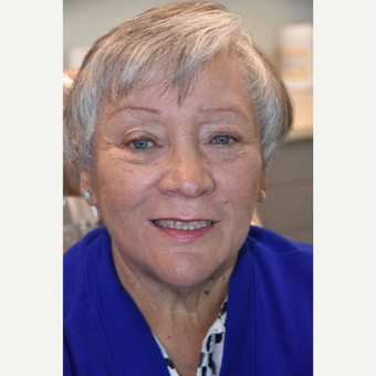 55-64 year old woman treated with All-on-4 Dental Implants after 3113881