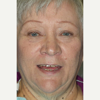 55-64 year old woman treated with All-on-4 Dental Implants before 3113881