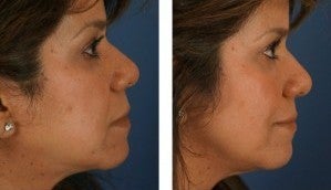 Dermal Fillers for Non-Surgical Cheek Enhancement after 1103997