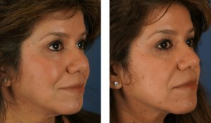 Dermal Fillers for Non-Surgical Cheek Enhancement 1103997