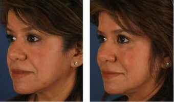 Dermal Fillers for Non-Surgical Cheek Enhancement before 1103997