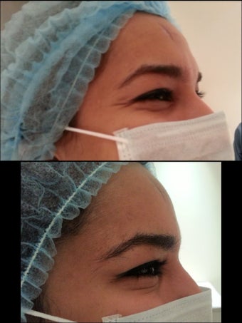 25 yrs old with crows feet (wrinkles around the eyes before 703906
