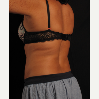 45-54 year old woman treated with CoolSculpting after 3371260