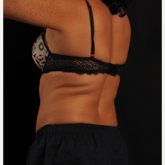 45-54 year old woman treated with CoolSculpting before 3371260