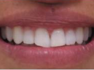 Invisalign - 40 Year Old Female, Extreme Crowding and Rotation, Occlusal Issues after 1498844