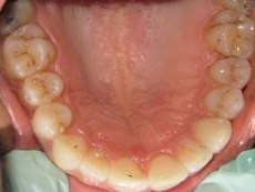 Invisalign - 40 Year Old Female, Extreme Crowding and Rotation, Occlusal Issues 1498844