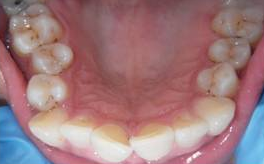 Invisalign - 40 Year Old Female, Extreme Crowding and Rotation, Occlusal Issues 1498844