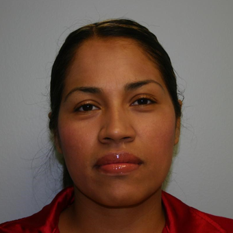 33 year old woman treated with Chin Liposuction after 3442279