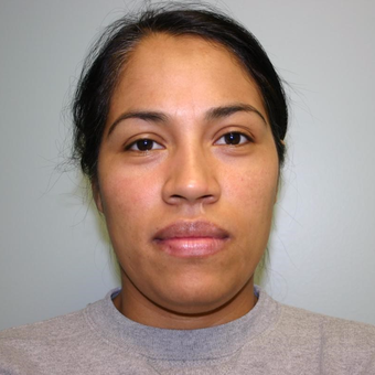 33 year old woman treated with Chin Liposuction before 3442279