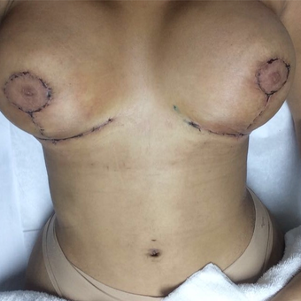 18-24 year old woman treated with Breast Lift with Implants after 3221798