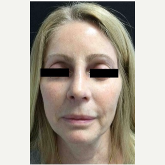 55-64 year old woman treated with Revision Rhinoplasty after 3187228
