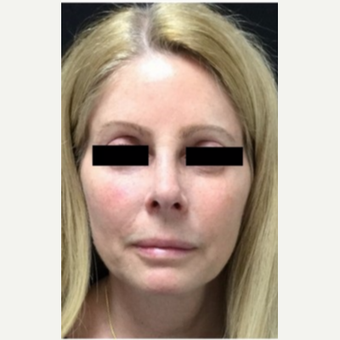 55-64 year old woman treated with Revision Rhinoplasty before 3187228