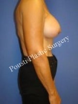 Breast Augmentation 705771