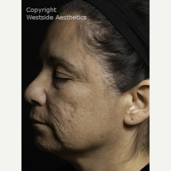 Fractional Laser for Acne Scars and Wrinkles after 3065399