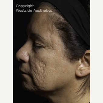 Fractional Laser for Acne Scars and Wrinkles before 3065399