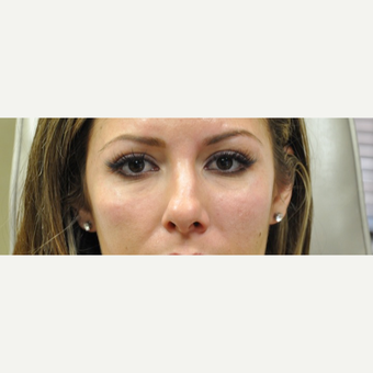 25-34 year old woman treated with Restylane after 3182002
