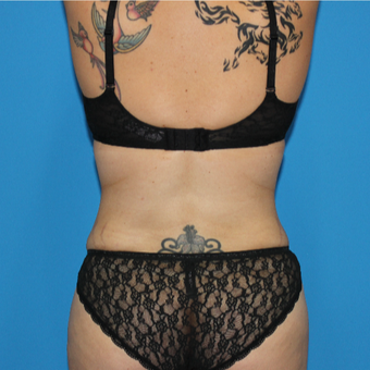 25-34 year old woman treated with Liposuction after 3332845