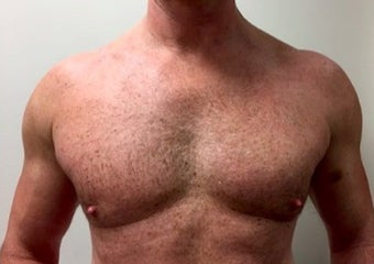 45-54 year old man treated with Liposculpture after 1740624