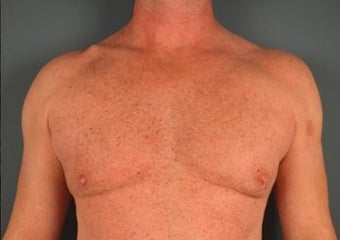 45-54 year old man treated with Liposculpture before 1740624