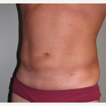 35-44 year old man treated with Liposuction after 3248810