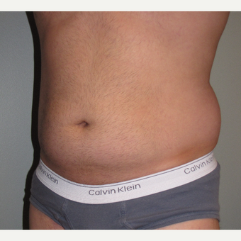 35-44 year old man treated with Liposuction before 3248810