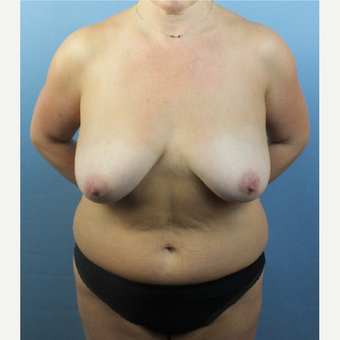 35-44 year old woman treated with Mommy Makeover before 3124110
