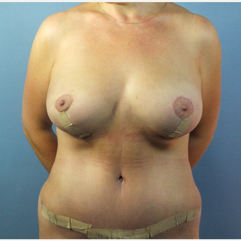 35-44 year old woman treated with Mommy Makeover after 3124110