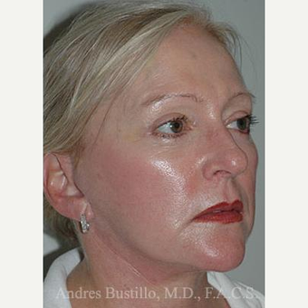 58 year old woman treated with Facelift after 3486303