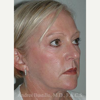 58 year old woman treated with Facelift before 3486303