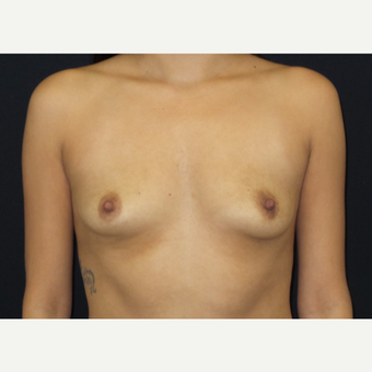 25-34 year old woman treated with Breast Augmentation before 3182094