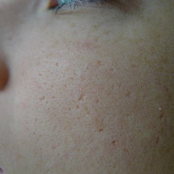TCA CROSS and laser resurfacing- perfect combination. before 2109862