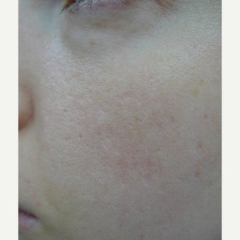 TCA CROSS and laser resurfacing- perfect combination. after 2109862