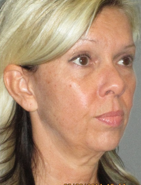 45-54 year old woman treated with Mini Lift before 2087753