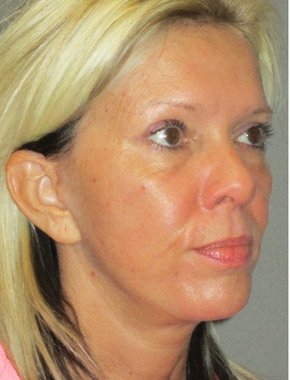 45-54 year old woman treated with Mini Lift after 2087753