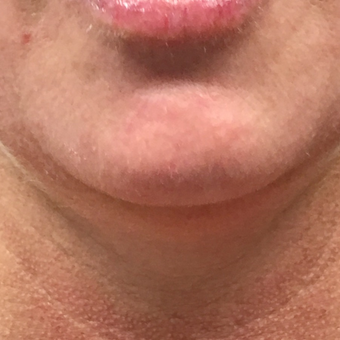 Precision Smart Lipo to sculpt stubborn fat from the under the chin: 45-54 year old female. before 3847534