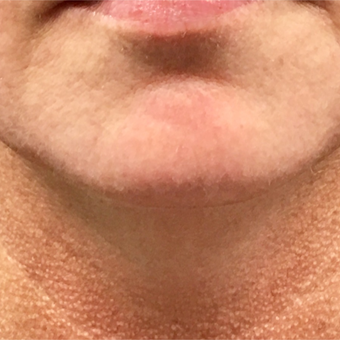 Precision Smart Lipo to sculpt stubborn fat from the under the chin: 45-54 year old female. after 3847534