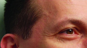 Botox before 460594