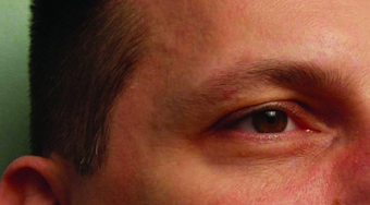 Botox after 460594