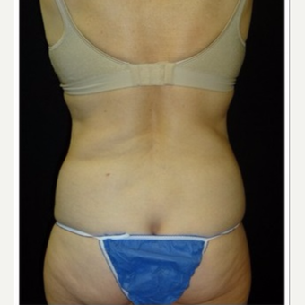 55-64 year old woman treated with CoolSculpting before 3181853