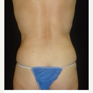 55-64 year old woman treated with CoolSculpting after 3181853