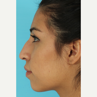 25-34 year old woman treated with Rhinoplasty before 3691045