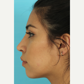 25-34 year old woman treated with Rhinoplasty after 3691045