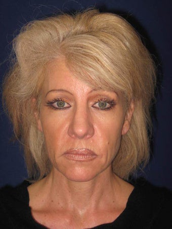 Mini Facelift before 1248510