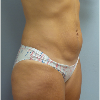 25-34 year old woman treated with Tummy Tuck before 3482332