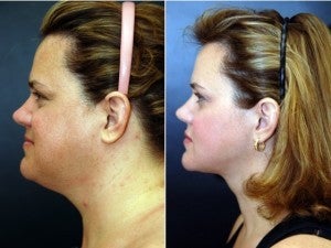 40 year old female following neck lift including lipocontouring and suspension before 1436606