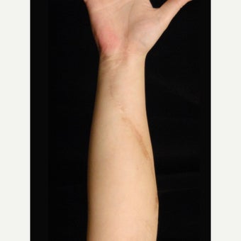 Arm Scar Revision after 1698002