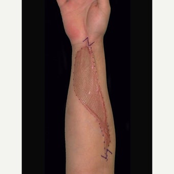 Arm Scar Revision before 1698002