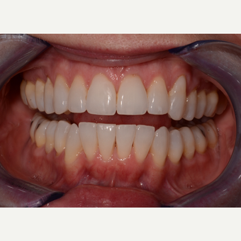 35-44 year old woman treated with Invisalign after 3735977